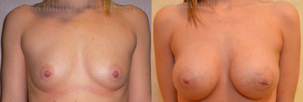 Breast Augmentation before and after photo by Columbus Institute of Plastic Surgery in Columbus, OH