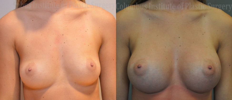 Breast Augmentation before and after photo by Columbus Institute of Plastic Surgery in Columbus, OH