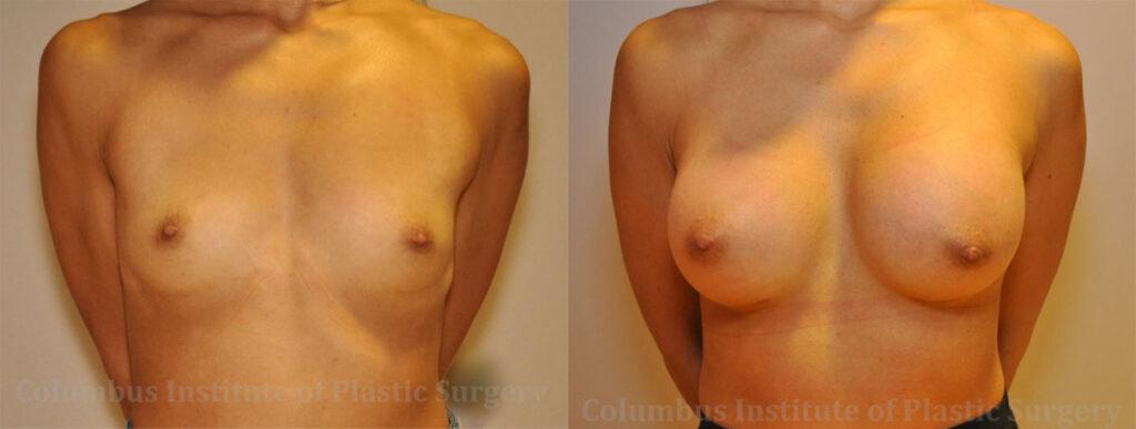 Breast Augmentation before and after photo by Columbus Institute of Plastic Surgery in Columbus, OH