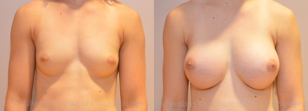 Breast Augmentation before and after photo by Columbus Institute of Plastic Surgery in Columbus, OH