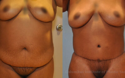 Abdominoplasty (Tummy Tuck) before and after photo by Columbus Institute of Plastic Surgery in Columbus, OH Abdominoplasty (Tummy Tuck) before and after photo by Columbus Institute of Plastic Surgery in Columbus, OH
