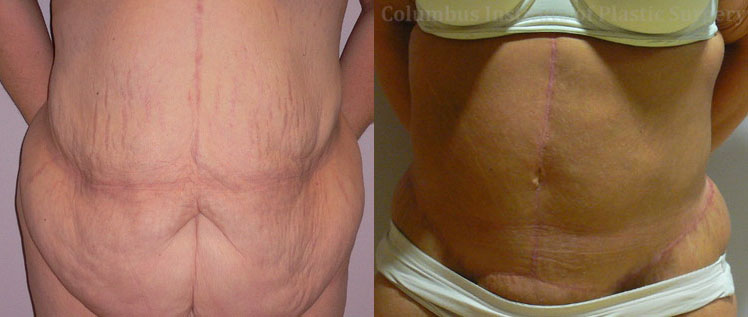 Abdominoplasty after Weight Loss before and after photo by Columbus Institute of Plastic Surgery in Columbus, OH