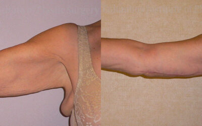 Brachioplasty (Arm Lift) before and after photo by Columbus Institute of Plastic Surgery in Columbus, OH Brachioplasty (Arm Lift) before and after photo by Columbus Institute of Plastic Surgery in Columbus, OH