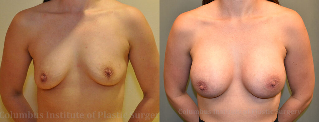 Breast Augmentation – 400cc-500cc before and after photo by Columbus Institute of Plastic Surgery in Columbus, OH