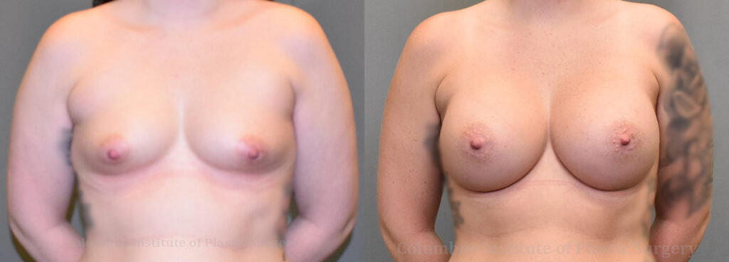 Breast Augmentation before and after photo by Columbus Institute of Plastic Surgery in Columbus, OH