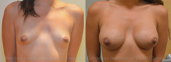 Breast Augmentation before and after photo by Columbus Institute of Plastic Surgery in Columbus, OH