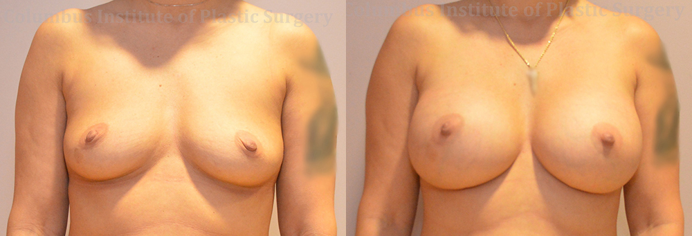 Breast Augmentation before and after photo by Columbus Institute of Plastic Surgery in Columbus, OH