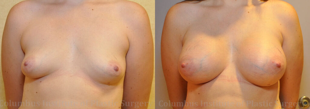 Breast Augmentation before and after photo by Columbus Institute of Plastic Surgery in Columbus, OH