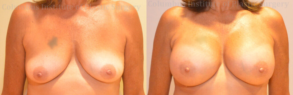 Breast Augmentation before and after photo by Columbus Institute of Plastic Surgery in Columbus, OH