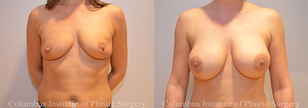 Breast Augmentation before and after photo by Columbus Institute of Plastic Surgery in Columbus, OH