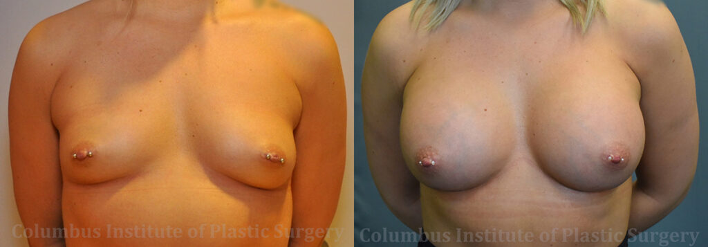 Breast Augmentation before and after photo by Columbus Institute of Plastic Surgery in Columbus, OH
