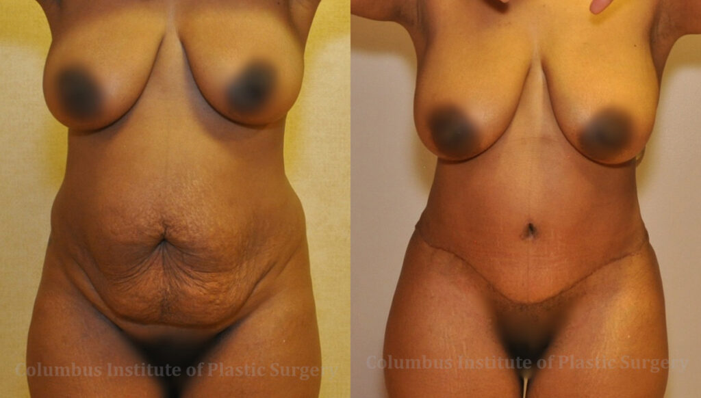 Abdominoplasty (Tummy Tuck) before and after photo by Columbus Institute of Plastic Surgery in Columbus, OH