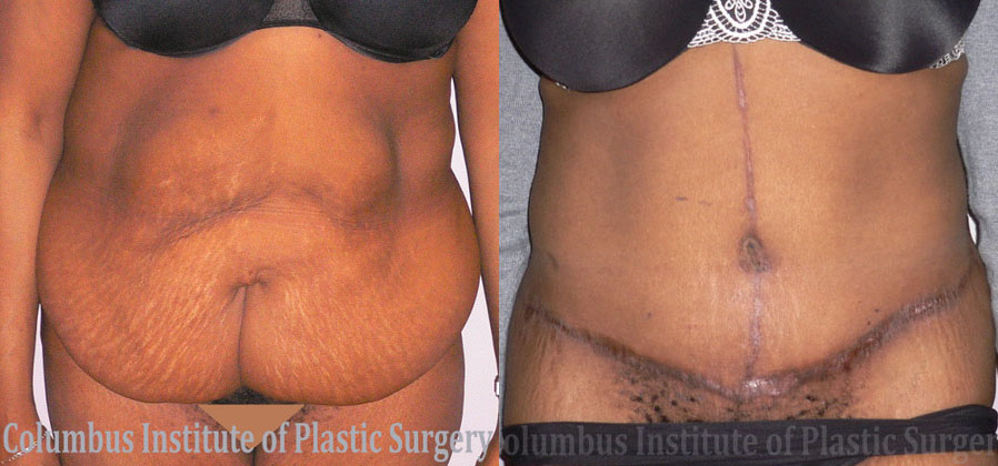 Abdominoplasty after Weight Loss before and after photo by Columbus Institute of Plastic Surgery in Columbus, OH