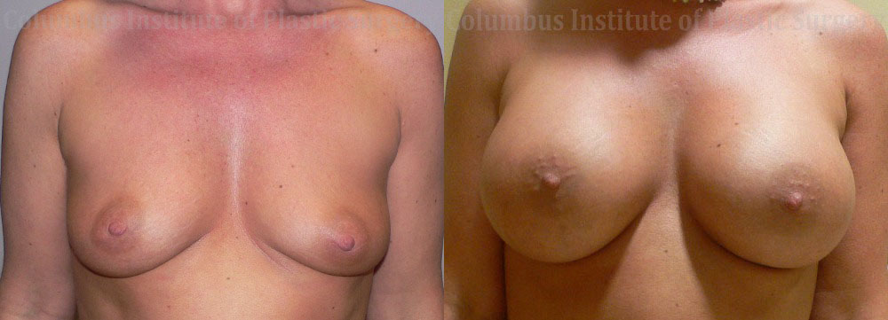 Breast Augmentation – 300cc-400cc before and after photo by Columbus Institute of Plastic Surgery in Columbus, OH