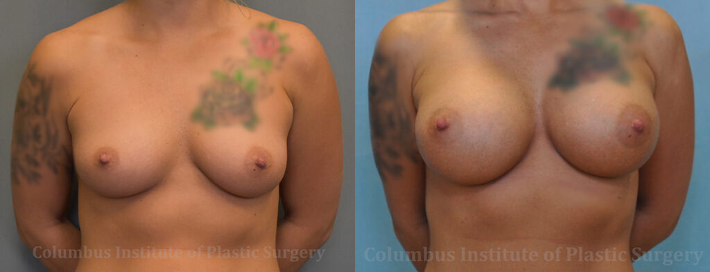 Breast Augmentation – 400cc-500cc before and after photo by Columbus Institute of Plastic Surgery in Columbus, OH