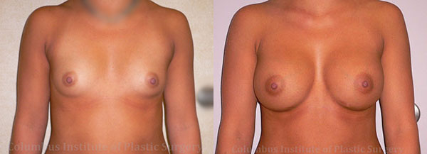 Breast Augmentation before and after photo by Columbus Institute of Plastic Surgery in Columbus, OH