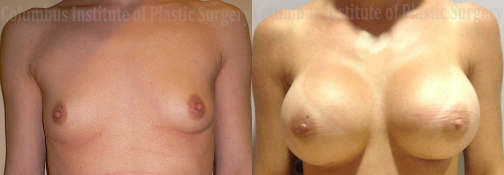 Breast Augmentation before and after photo by Columbus Institute of Plastic Surgery in Columbus, OH
