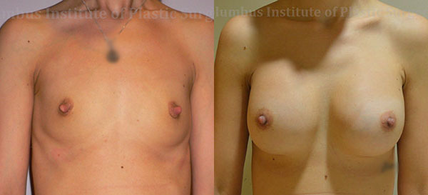 Breast Augmentation before and after photo by Columbus Institute of Plastic Surgery in Columbus, OH