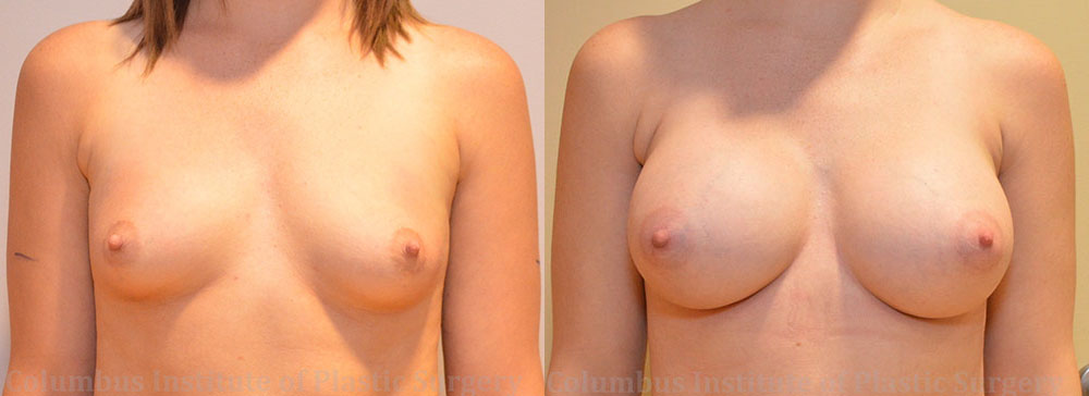 Breast Augmentation before and after photo by Columbus Institute of Plastic Surgery in Columbus, OH