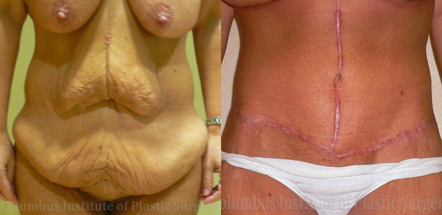 Abdominoplasty after Weight Loss before and after photo by Columbus Institute of Plastic Surgery in Columbus, OH