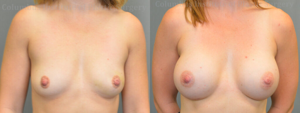 Breast Augmentation before and after photo by Columbus Institute of Plastic Surgery in Columbus, OH