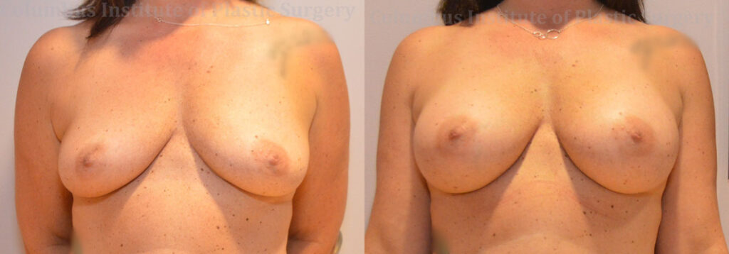 Breast Augmentation before and after photo by Columbus Institute of Plastic Surgery in Columbus, OH