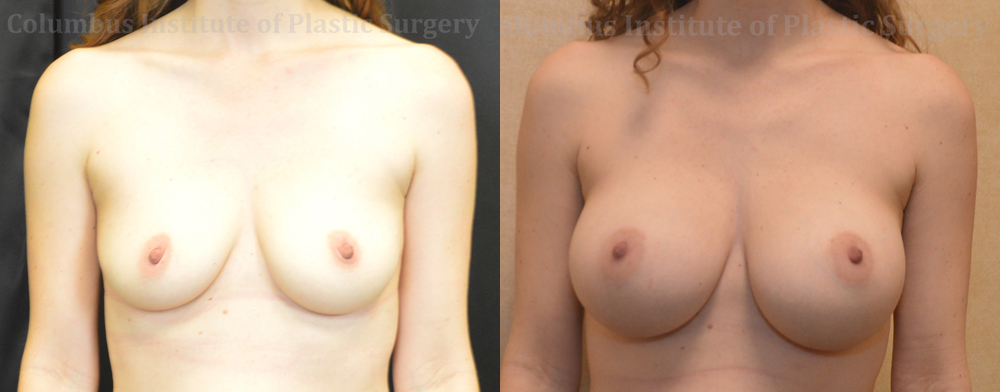 Breast Augmentation before and after photo by Columbus Institute of Plastic Surgery in Columbus, OH