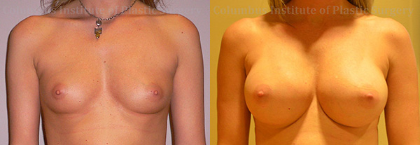 Breast Augmentation before and after photo by Columbus Institute of Plastic Surgery in Columbus, OH