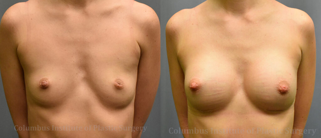 Breast Augmentation before and after photo by Columbus Institute of Plastic Surgery in Columbus, OH