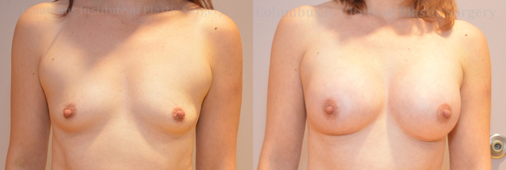 Breast Augmentation before and after photo by Columbus Institute of Plastic Surgery in Columbus, OH