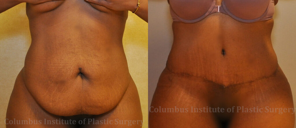 Abdominoplasty (Tummy Tuck) before and after photo by Columbus Institute of Plastic Surgery in Columbus, OH