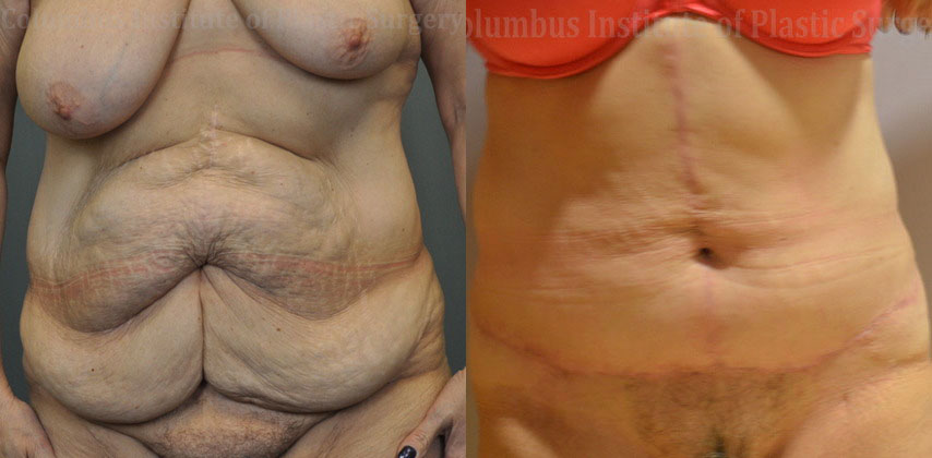 Abdominoplasty after Weight Loss before and after photo by Columbus Institute of Plastic Surgery in Columbus, OH