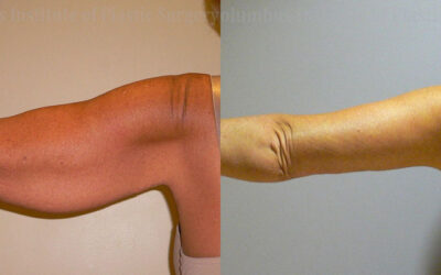 Brachioplasty (Arm Lift) before and after photo by Columbus Institute of Plastic Surgery in Columbus, OH Brachioplasty (Arm Lift) before and after photo by Columbus Institute of Plastic Surgery in Columbus, OH
