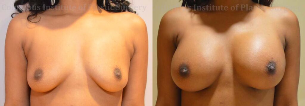 Breast Augmentation before and after photo by Columbus Institute of Plastic Surgery in Columbus, OH