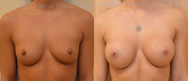 Breast Augmentation before and after photo by Columbus Institute of Plastic Surgery in Columbus, OH