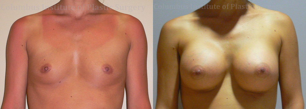 Breast Augmentation before and after photo by Columbus Institute of Plastic Surgery in Columbus, OH