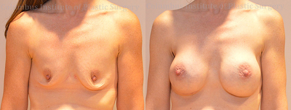 Breast Augmentation before and after photo by Columbus Institute of Plastic Surgery in Columbus, OH