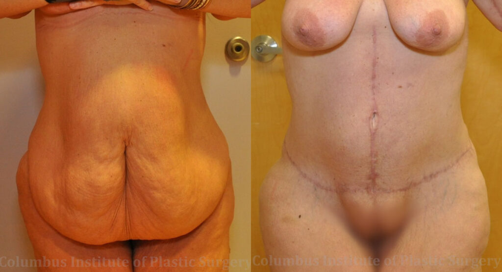 Abdominoplasty after Weight Loss before and after photo by Columbus Institute of Plastic Surgery in Columbus, OH