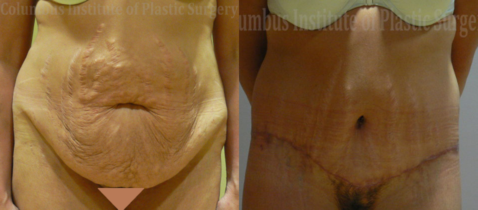 Belt Lipectomy before and after photo by Columbus Institute of Plastic Surgery in Columbus, OH