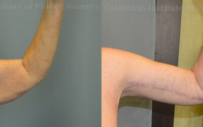 Brachioplasty (Arm Lift) before and after photo by Columbus Institute of Plastic Surgery in Columbus, OH Brachioplasty (Arm Lift) before and after photo by Columbus Institute of Plastic Surgery in Columbus, OH