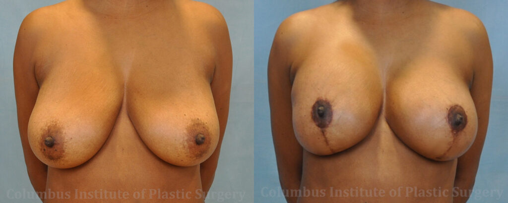 Breast Augmentation – 400cc-500cc before and after photo by Columbus Institute of Plastic Surgery in Columbus, OH
