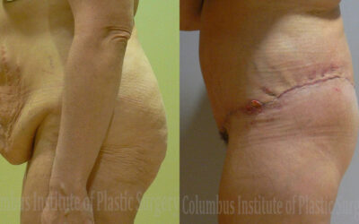 Belt Lipectomy before and after photo by Columbus Institute of Plastic Surgery in Columbus, OH Belt Lipectomy before and after photo by Columbus Institute of Plastic Surgery in Columbus, OH