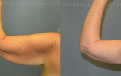 Brachioplasty (Arm Lift) before and after photo by Columbus Institute of Plastic Surgery in Columbus, OH Brachioplasty (Arm Lift) before and after photo by Columbus Institute of Plastic Surgery in Columbus, OH