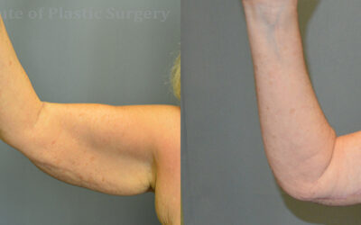 Brachioplasty (Arm Lift) before and after photo by Columbus Institute of Plastic Surgery in Columbus, OH Brachioplasty (Arm Lift) before and after photo by Columbus Institute of Plastic Surgery in Columbus, OH