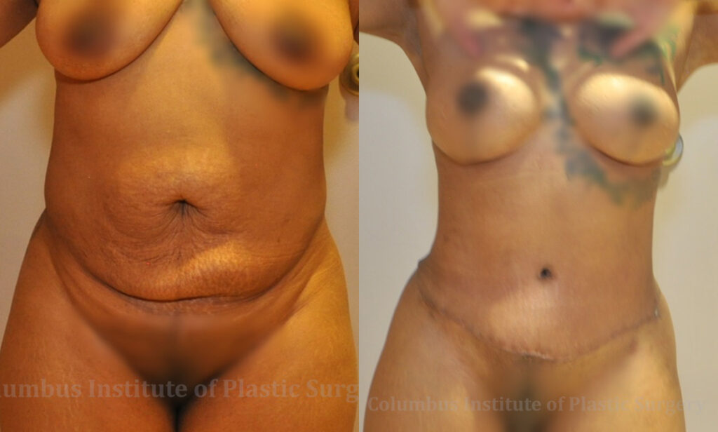 Abdominoplasty (Tummy Tuck) before and after photo by Columbus Institute of Plastic Surgery in Columbus, OH
