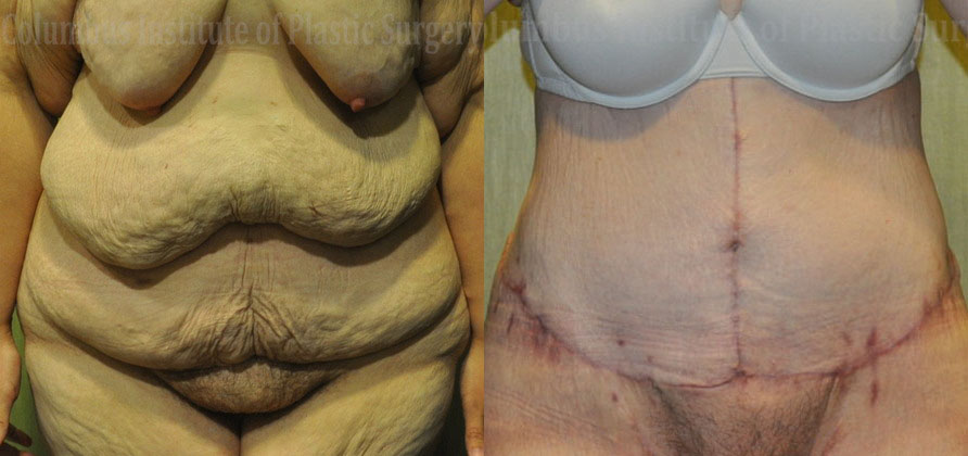 Abdominoplasty after Weight Loss before and after photo by Columbus Institute of Plastic Surgery in Columbus, OH