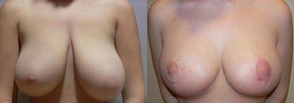Breast Reduction before and after photo by Columbus Institute of Plastic Surgery in Columbus, OH