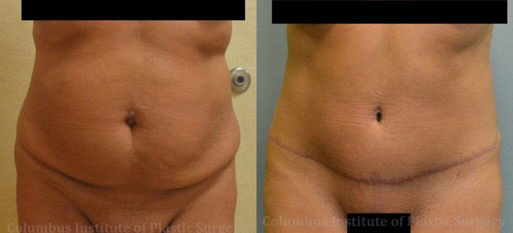 Abdominoplasty (Tummy Tuck) before and after photo by Columbus Institute of Plastic Surgery in Columbus, OH