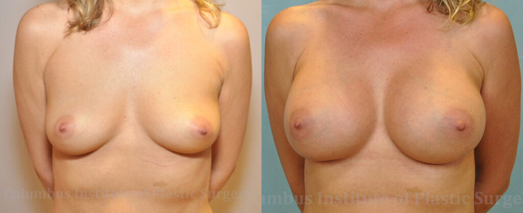 Breast Augmentation – 400cc-500cc before and after photo by Columbus Institute of Plastic Surgery in Columbus, OH