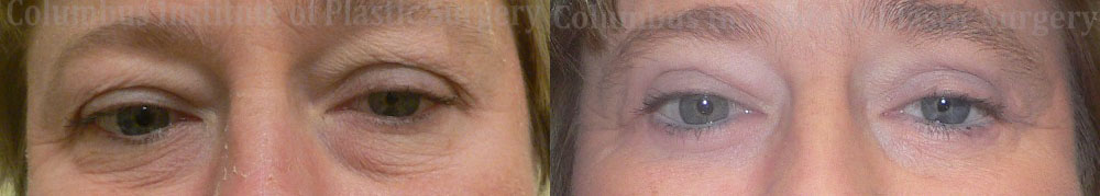 Blepharoplasty before and after photo by Columbus Institute of Plastic Surgery in Columbus, OH